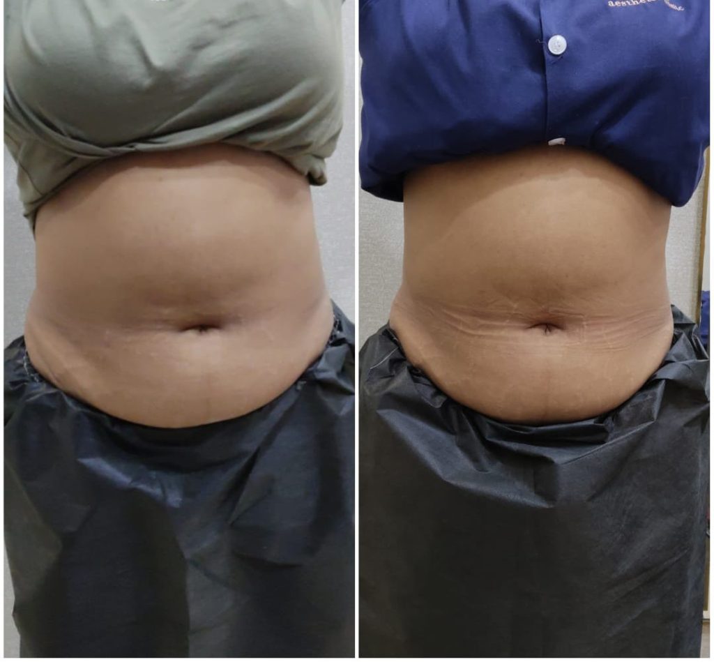Fat loss