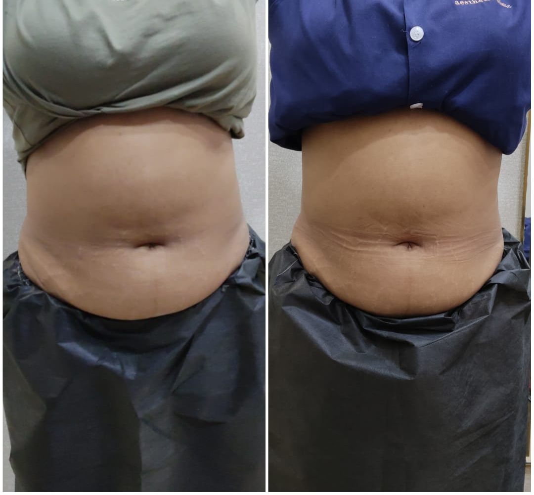 Fat loss