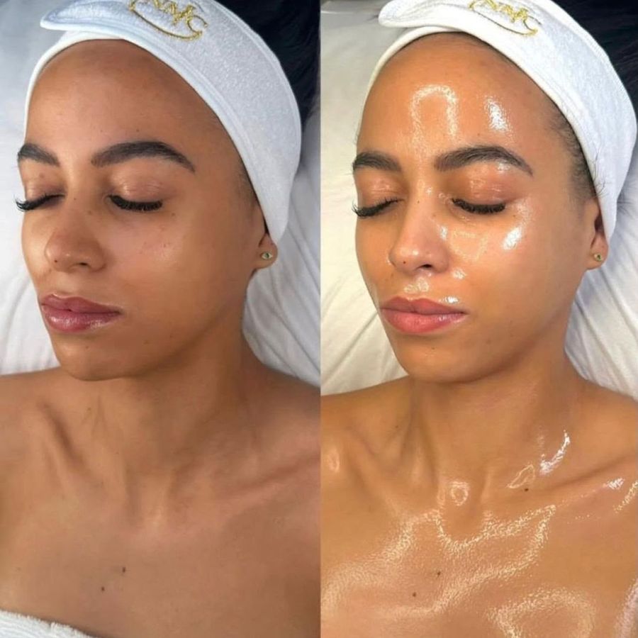HydraFacial before and after result 1