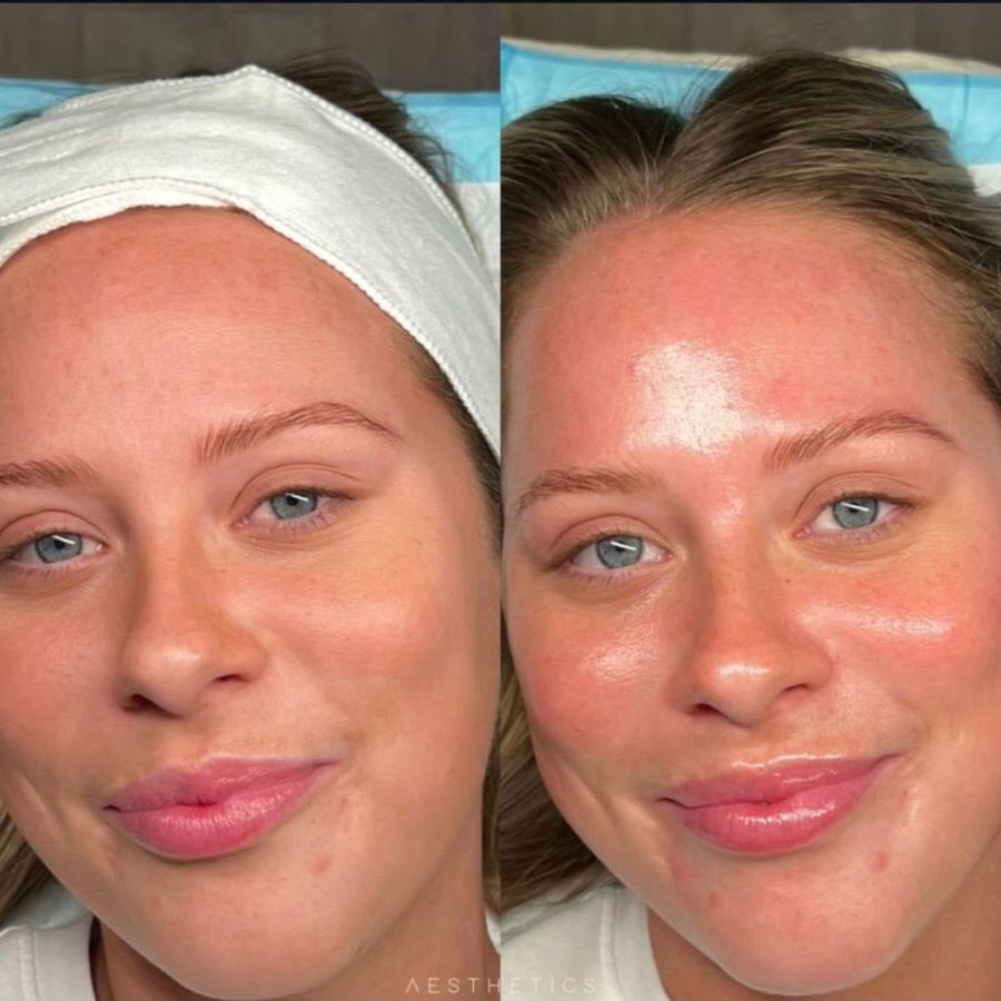 HydraFacial before and after result 2