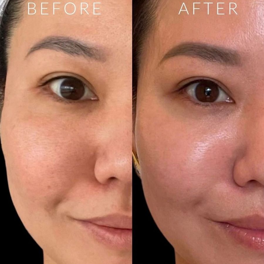 HydraFacial before and after result 3