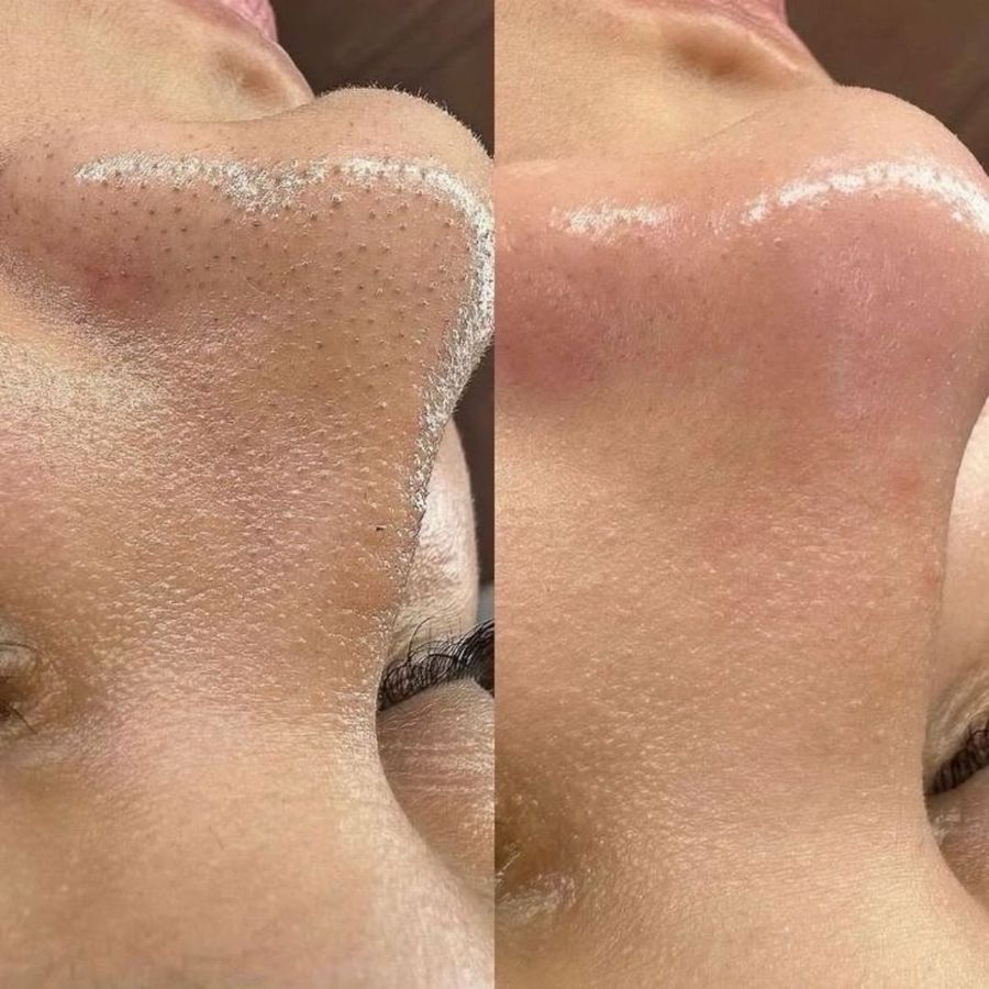 HydraFacial before and after result 4
