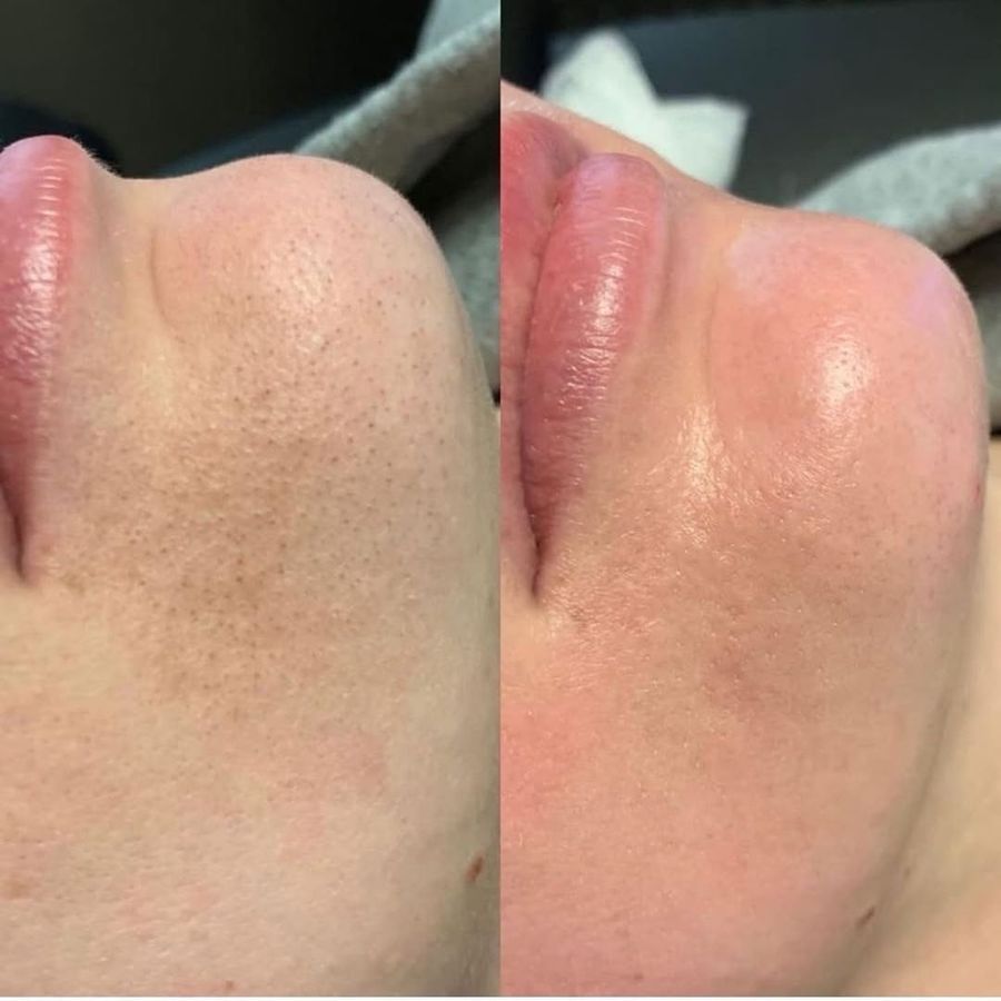 HydraFacial before and after result 5