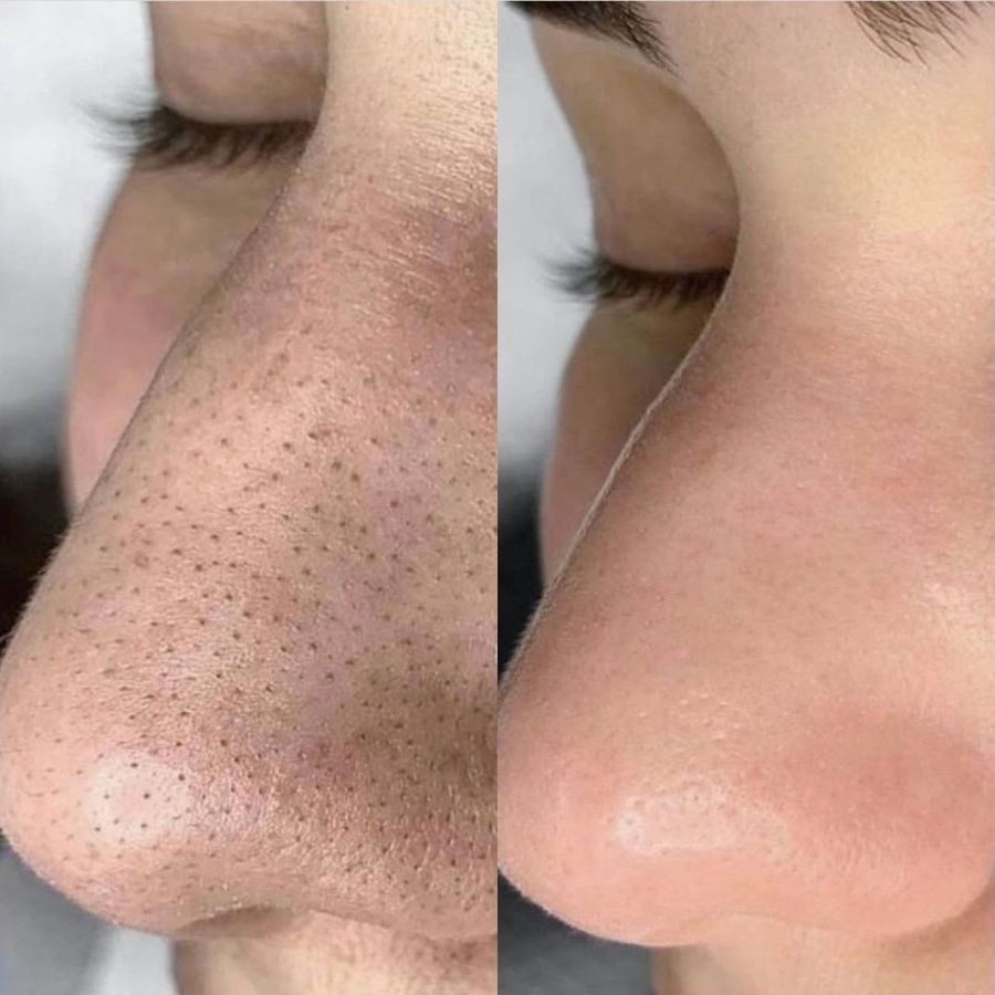 HydraFacial before and after result 6