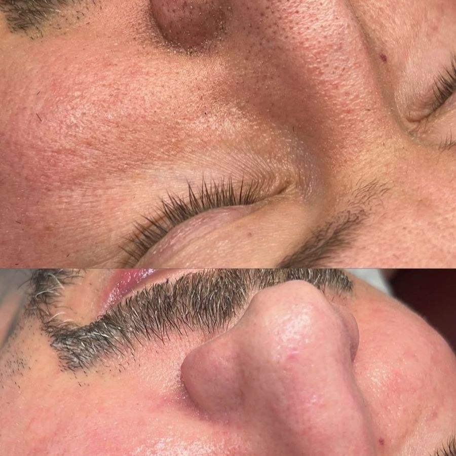 HydraFacial before and after result 7