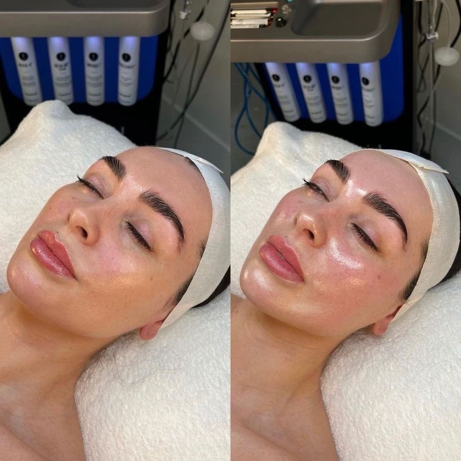 HydraFacial before and after result 8