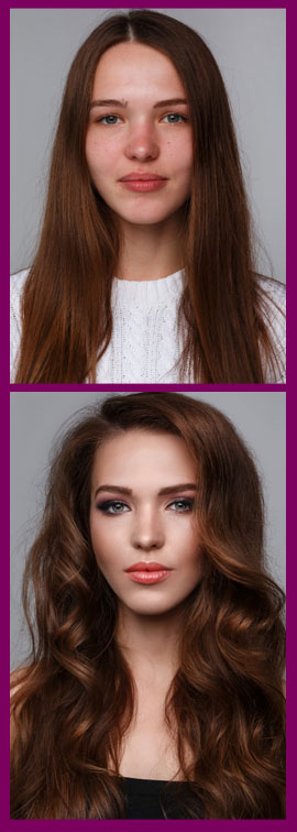 Female Hair Transplant Before and After