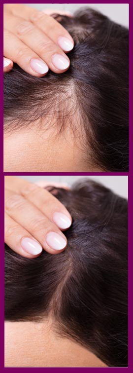 Hairline Reconstruction