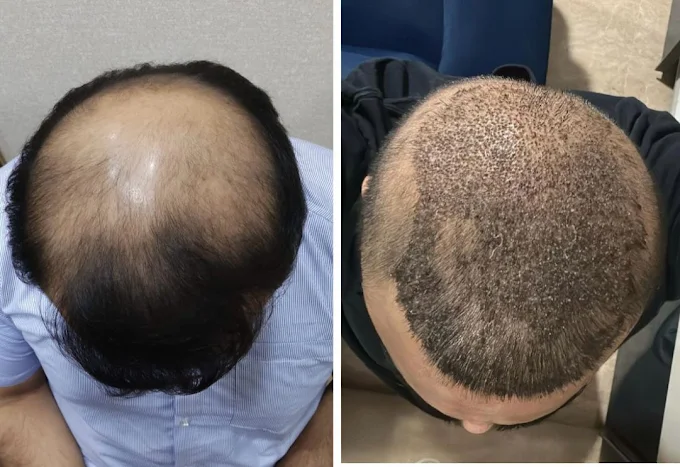 Hair Transplant clinic in thane